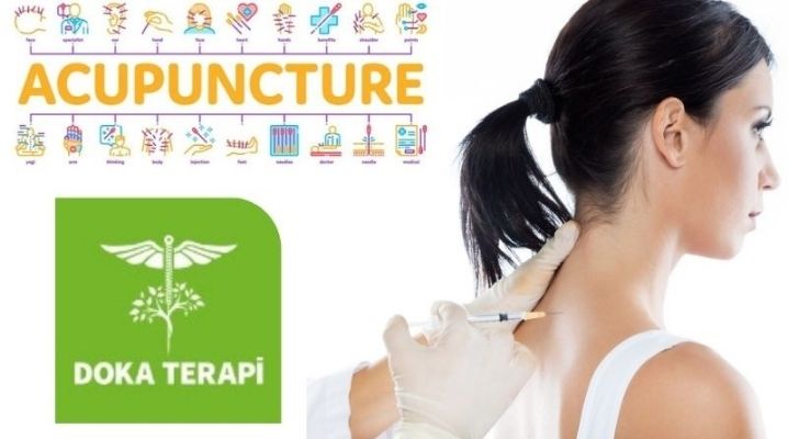 Acupuncture yazısı ve tedavi olan bir kadın hasta